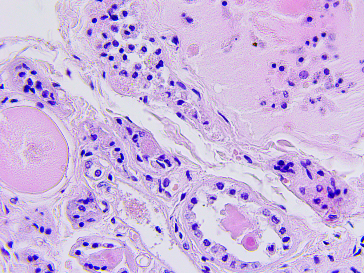 Biopsia della prostata: domande e risposte