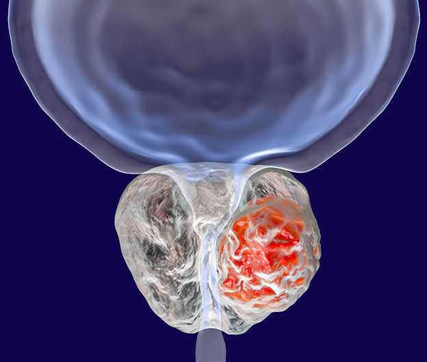 Prostatectomia radicale per il carcinoma prostatico localizzato